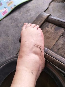 揪痧治咽炎主播照片