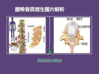 腰椎骨质增生症状