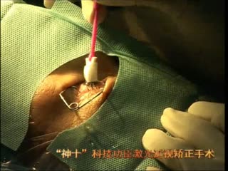 “曙光·神十心连心”近视矫正手术